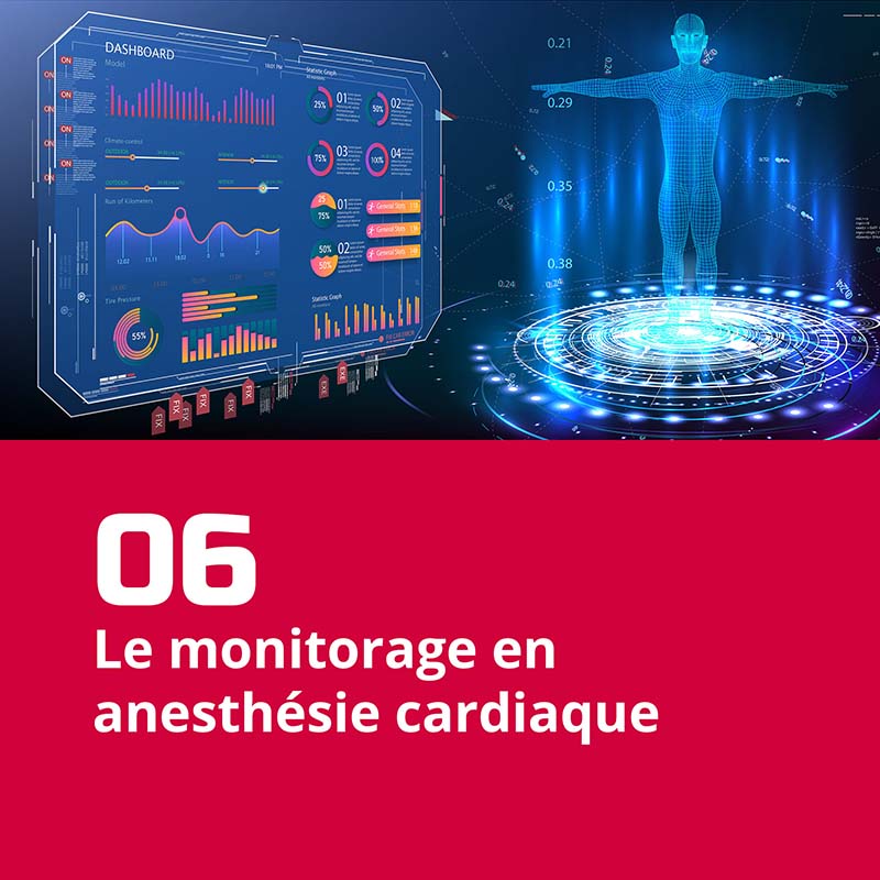 06. Le monitorage en anesthésie cardiaque