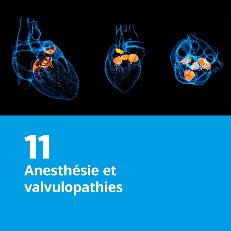 11. Anesthésie et valvulopathies