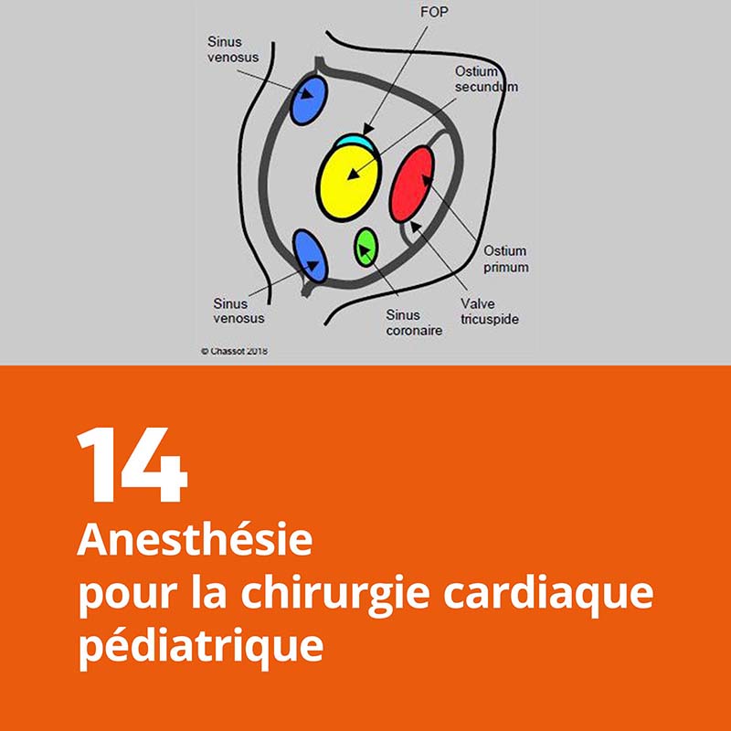 14. Anesthésie pour la chirurgie cardiaque pédiatrique