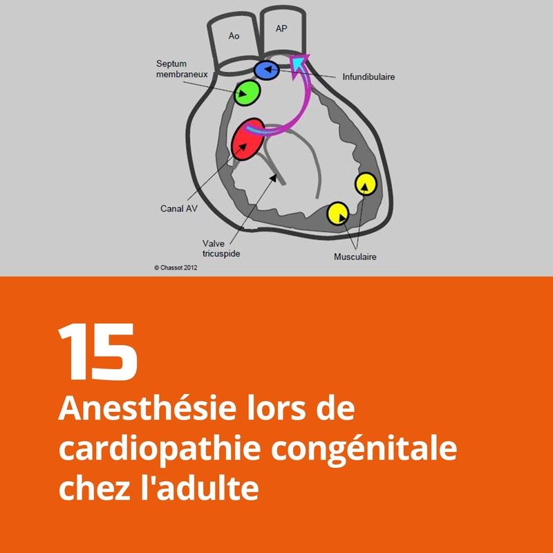 15. Anesthésie lors de cardiopathie congénitale chez l'adulte