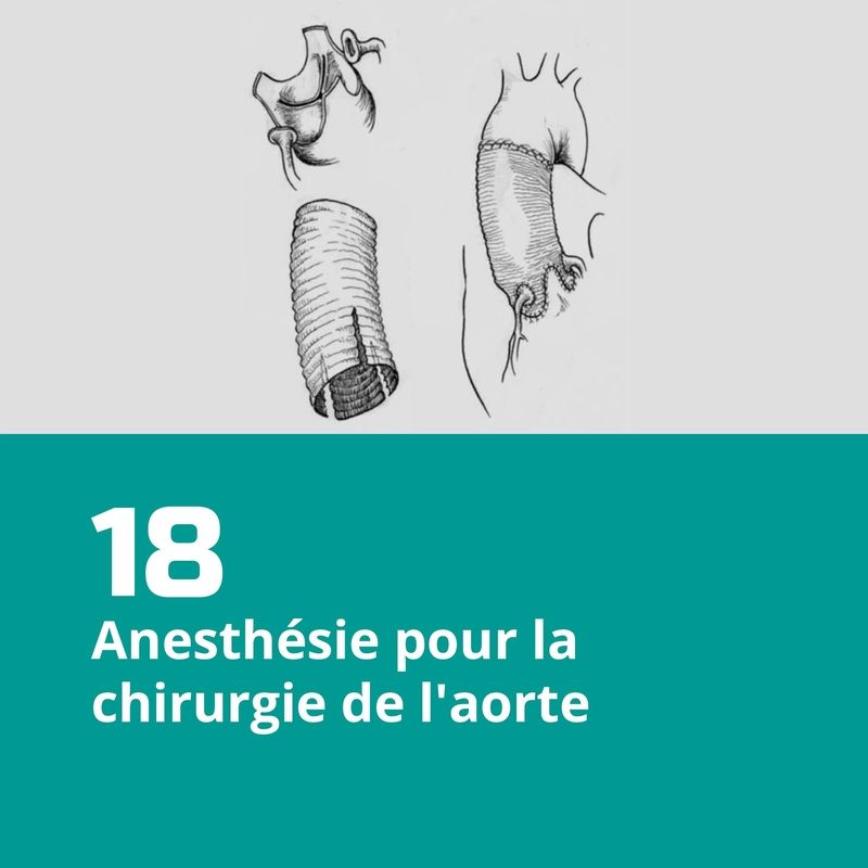 18. Anesthésie pour la chirurgie de l'aorte