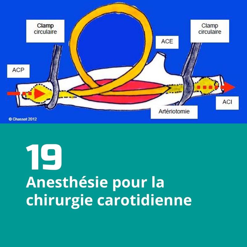 19. Anesthésie pour la chirurgie carotidienne