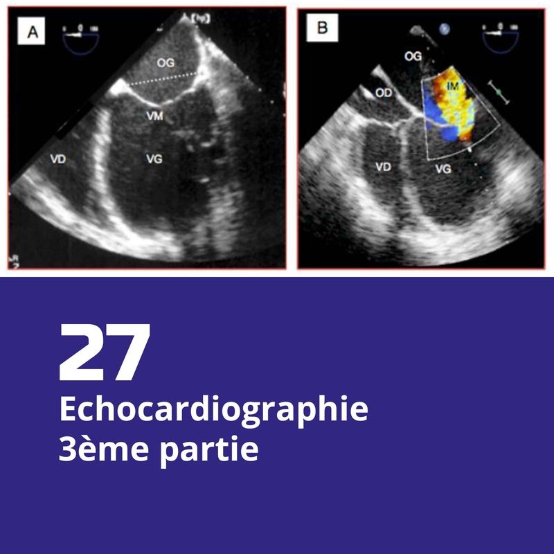 27. Echocardiographie, 3ème partie