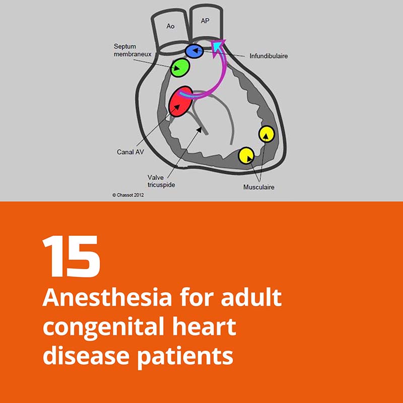 15. Anesthesia for adult congenital heart disease patients